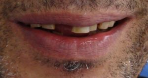 antes