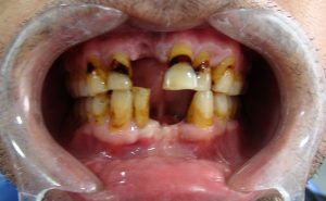 dientes-antes