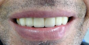 sonrisa-protesis-fija